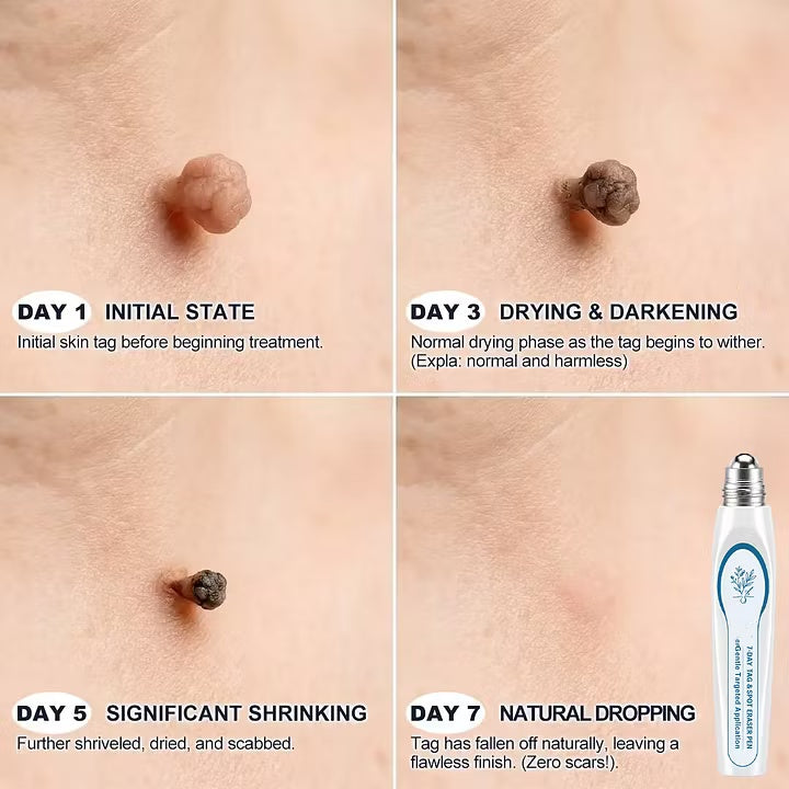 7-Day Skin Tag & Spot Eraser Painless & Scar-Free Advanced Imperfection Removal Rollerball Pen🍓