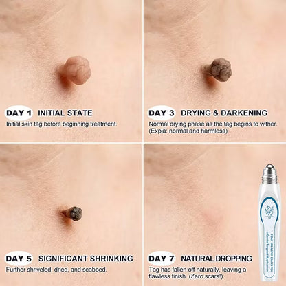 7-Day Skin Tag & Spot Eraser Painless & Scar-Free Advanced Imperfection Removal Rollerball Pen🍓