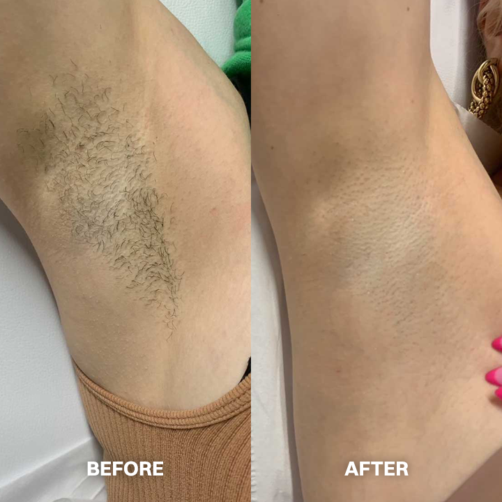💯Hair Removal Cream for All Women & Men💯